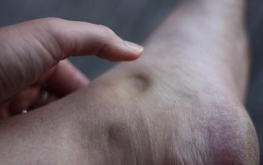Xinjirowga Xididdada Lugaha / Deep Vein Thrombosis (DVT)