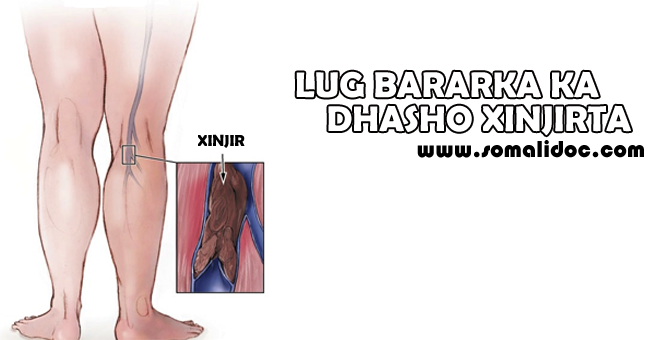 Xinjirowga Xididdada Lugaha / Deep Vein Thrombosis (DVT)